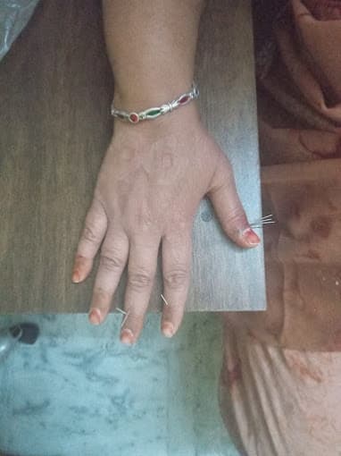 Sujok Acupuncture Treatment Session