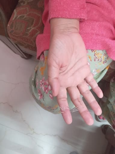 Sujok Therapy Treatment for Various Conditions